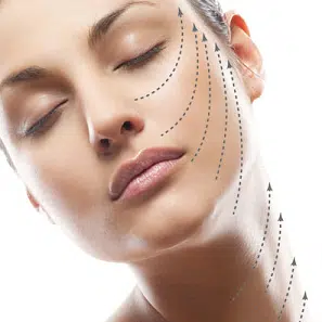 thread-lift-facelift pdo thread lift lima