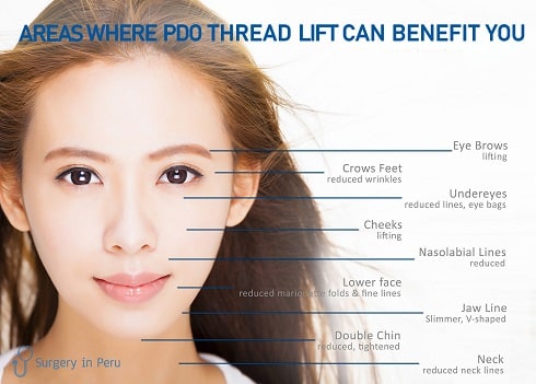 thread lift