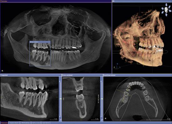 3D tomography