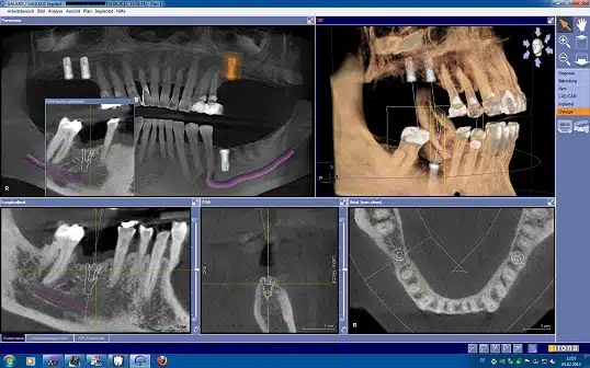 tomography dental implant planning affordable dental implants in lima peru