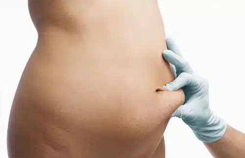 abdominoplastia