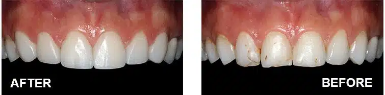 veneers diseño sonrisa