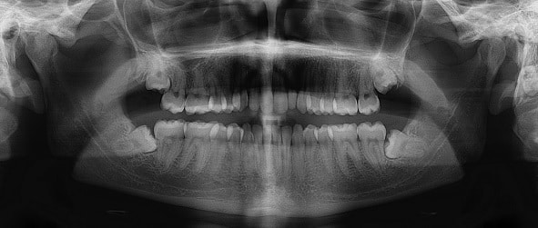 wisdom teeth extractions