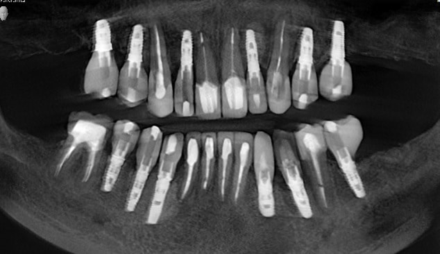 full mouth reconstruction