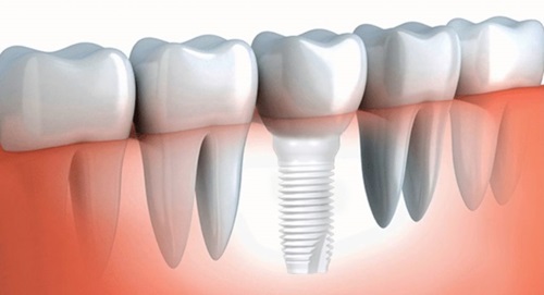 zirconium dental implants in Lima, Peru