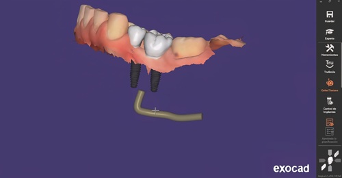 zirconium dental implant digital planning